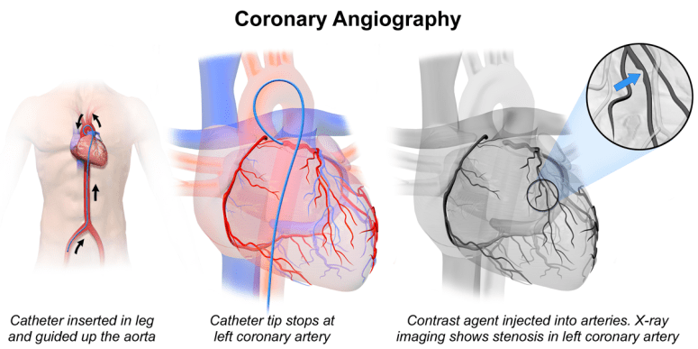 Coronary_Angiography