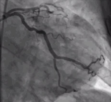 Coronary_angiography_of_a_STEMI_patient_with_partial_occlusion_of_left_circumflex_coronary_artery,_after_being_treated_with_percoutaneous_coronary_intervention