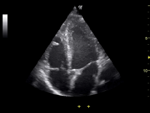 Tte Test What is a transthoracic echocardiogram (TTE)? – Australian Heart