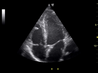 Ultrasound_of_human_heart_apical_4-cahmber_view.gif